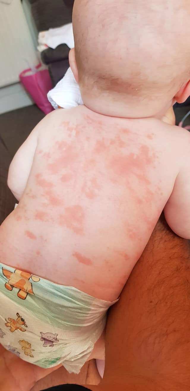 Baby left with lifelong heart condition after suffering Covid-linked syndrome