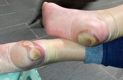 Pic of Pfizer Covid vaccine trial patient’s foot covered in sores used to spread anti-vaxxer propaganda about jab