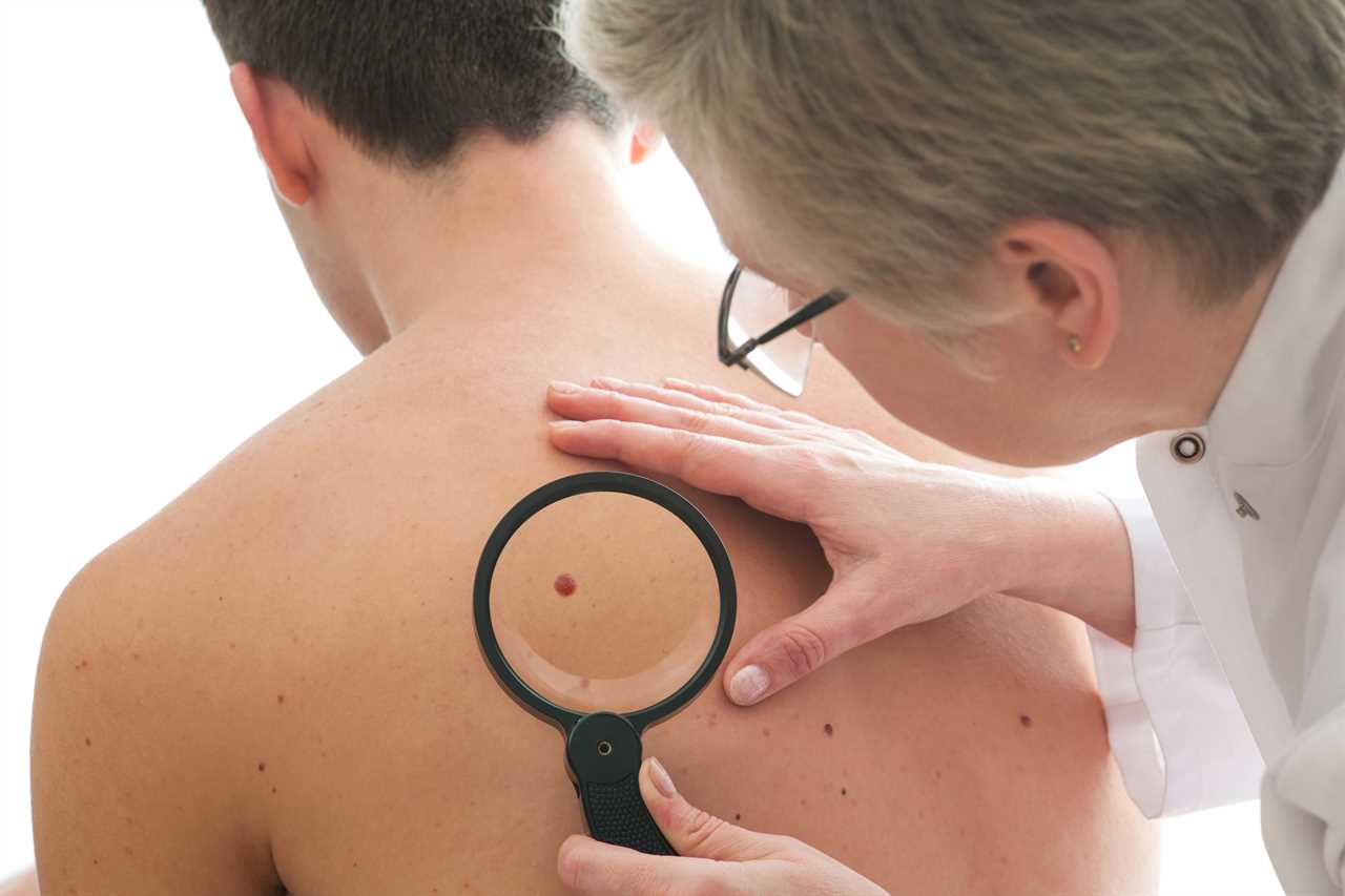 Thousands at risk as 1 in 5 skin cancer cases missed during Covid pandemic – 5 sign to watch out for