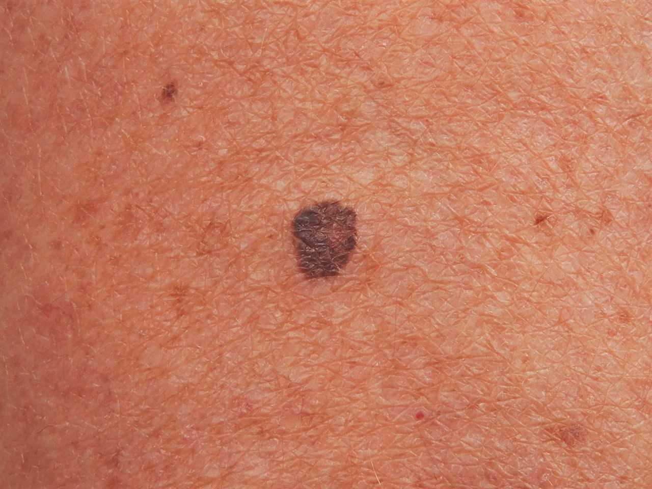 Thousands at risk as 1 in 5 skin cancer cases missed during Covid pandemic – 5 sign to watch out for