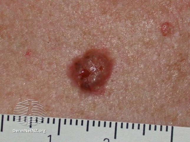 Around 75 per cent of all skin cancers are basal cell carcinomas, pictured