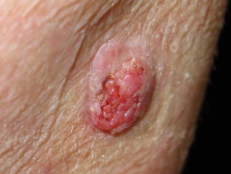 Thousands at risk as 1 in 5 skin cancer cases missed during Covid pandemic – 5 sign to watch out for