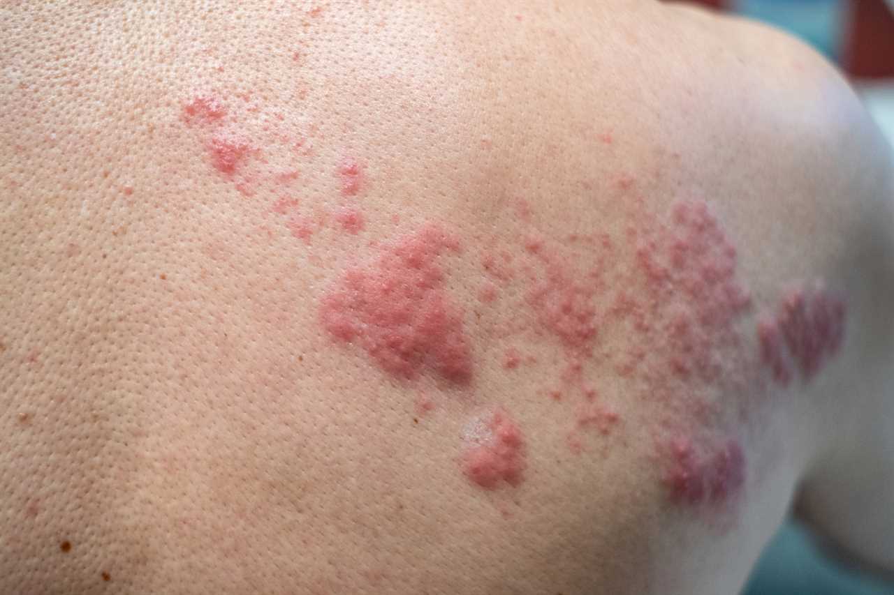 Shingles could be new but rare side effect of Covid vaccine, docs discover