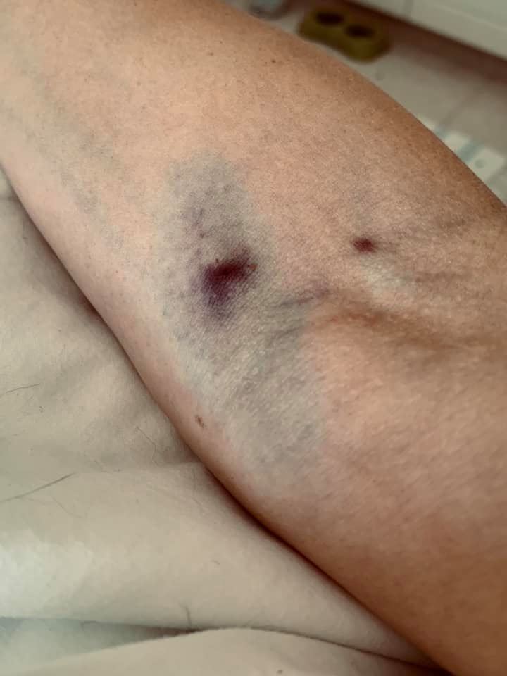 She shared what would be her final Facebook post - a picture of her bruised arm