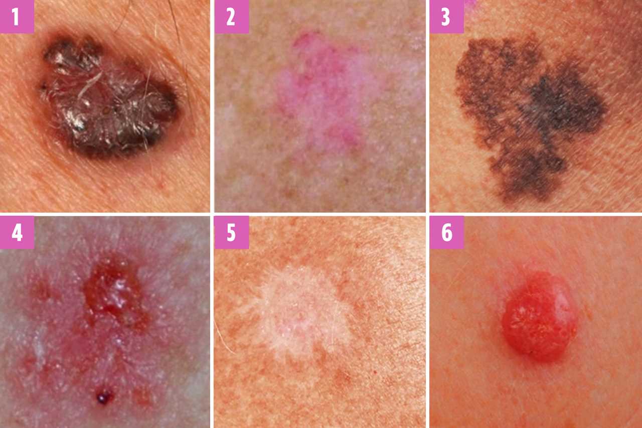 Can you spot which moles are deadly? The skin cancer signs you need to know