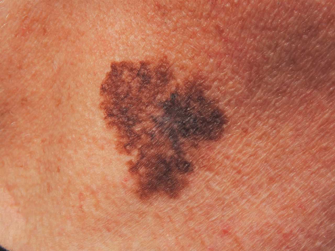 Can you spot which moles are deadly? The skin cancer signs you need to know