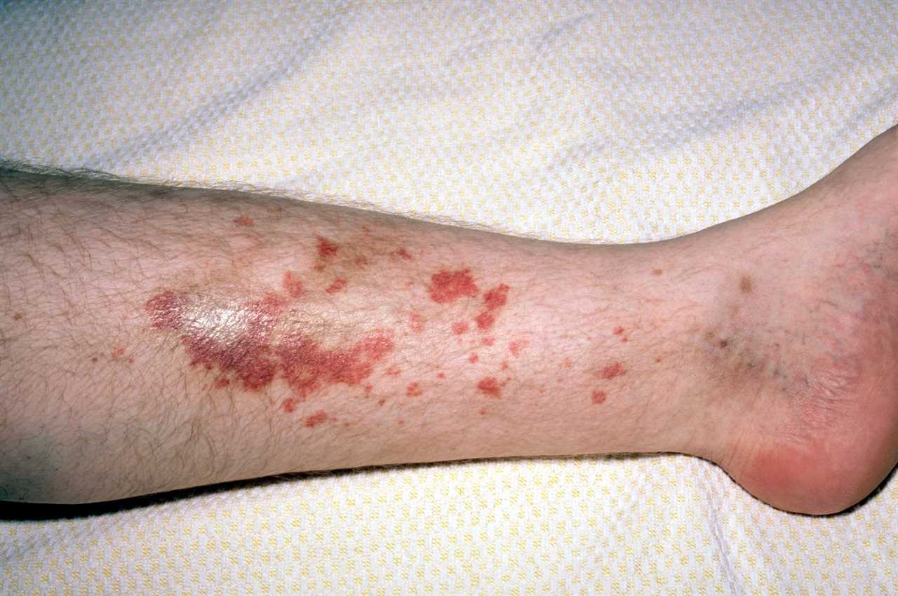 Mycosis fungoides appears as a patchy red rash in its early stages