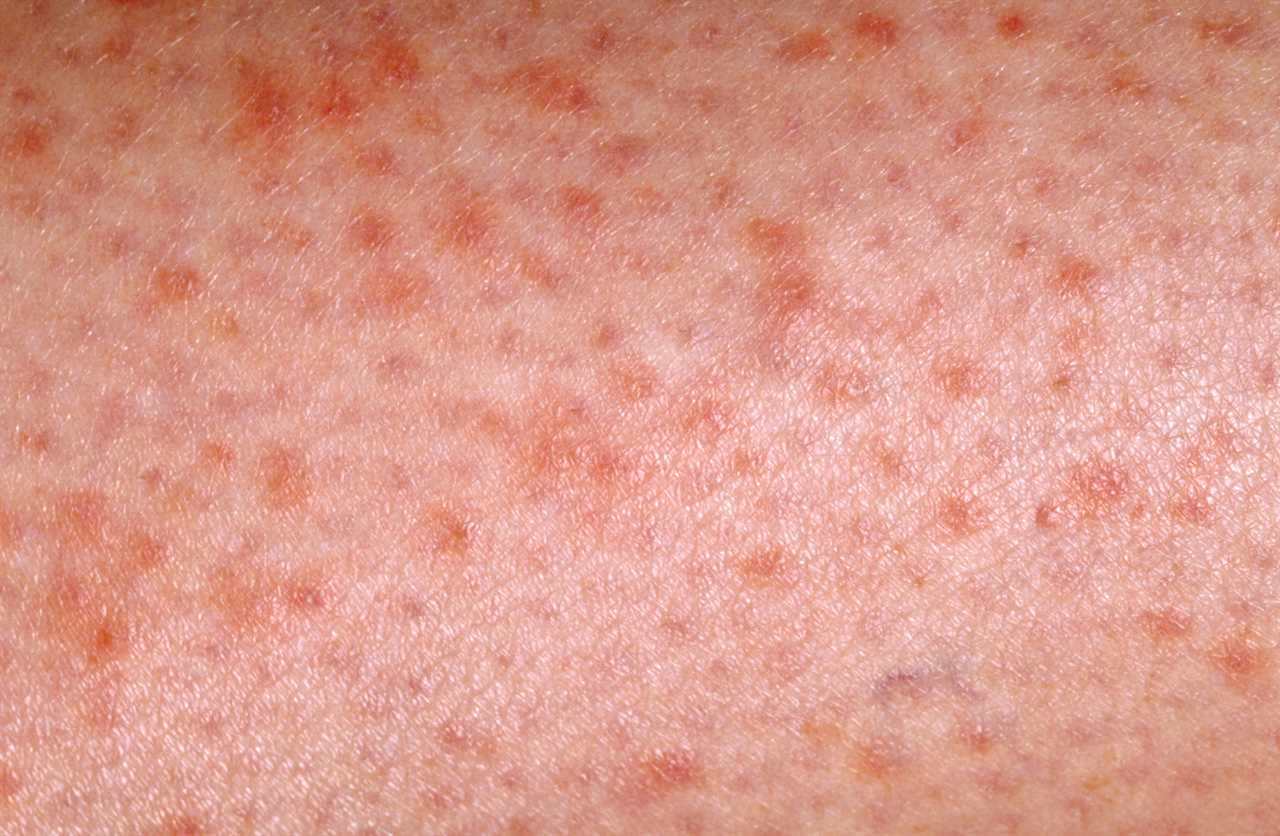 Petechiae is caused by broken blood vessels under the skin