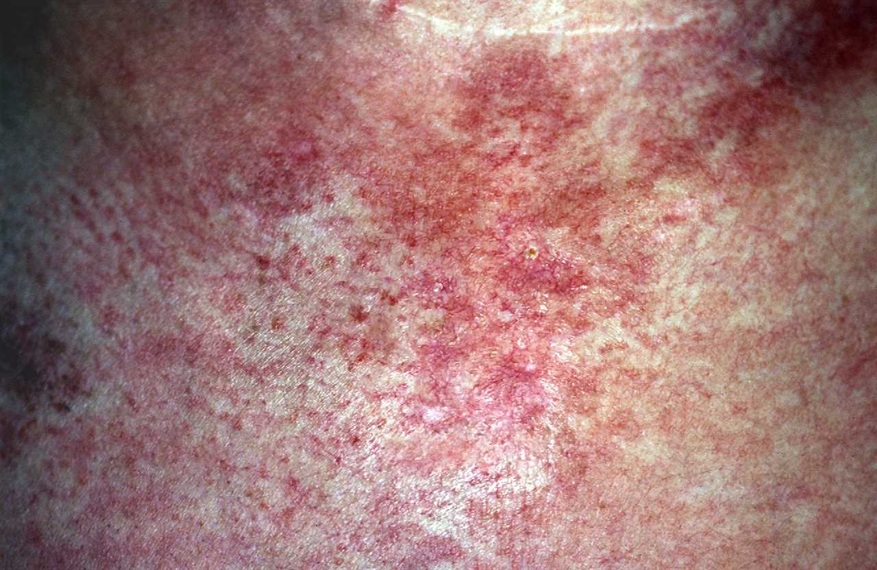 Dermatomyositis usually causes a red shawl-like rash on the back