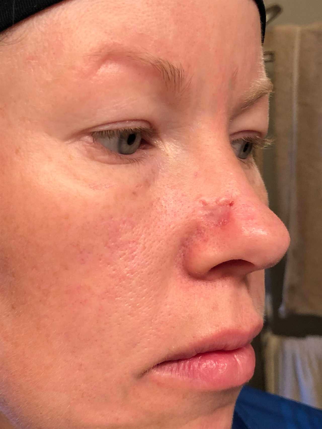 I couldn’t look at myself after acne scar turned cancerous and left gaping hole in my nose