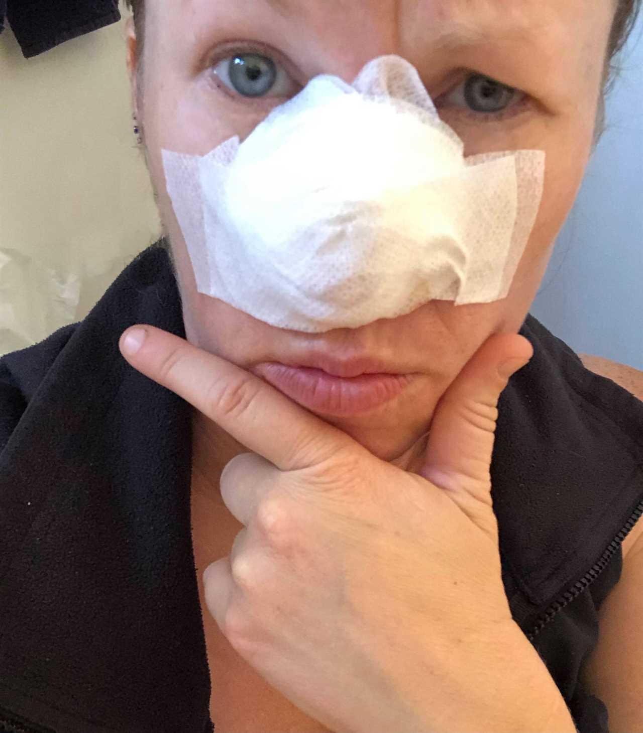 I couldn’t look at myself after acne scar turned cancerous and left gaping hole in my nose