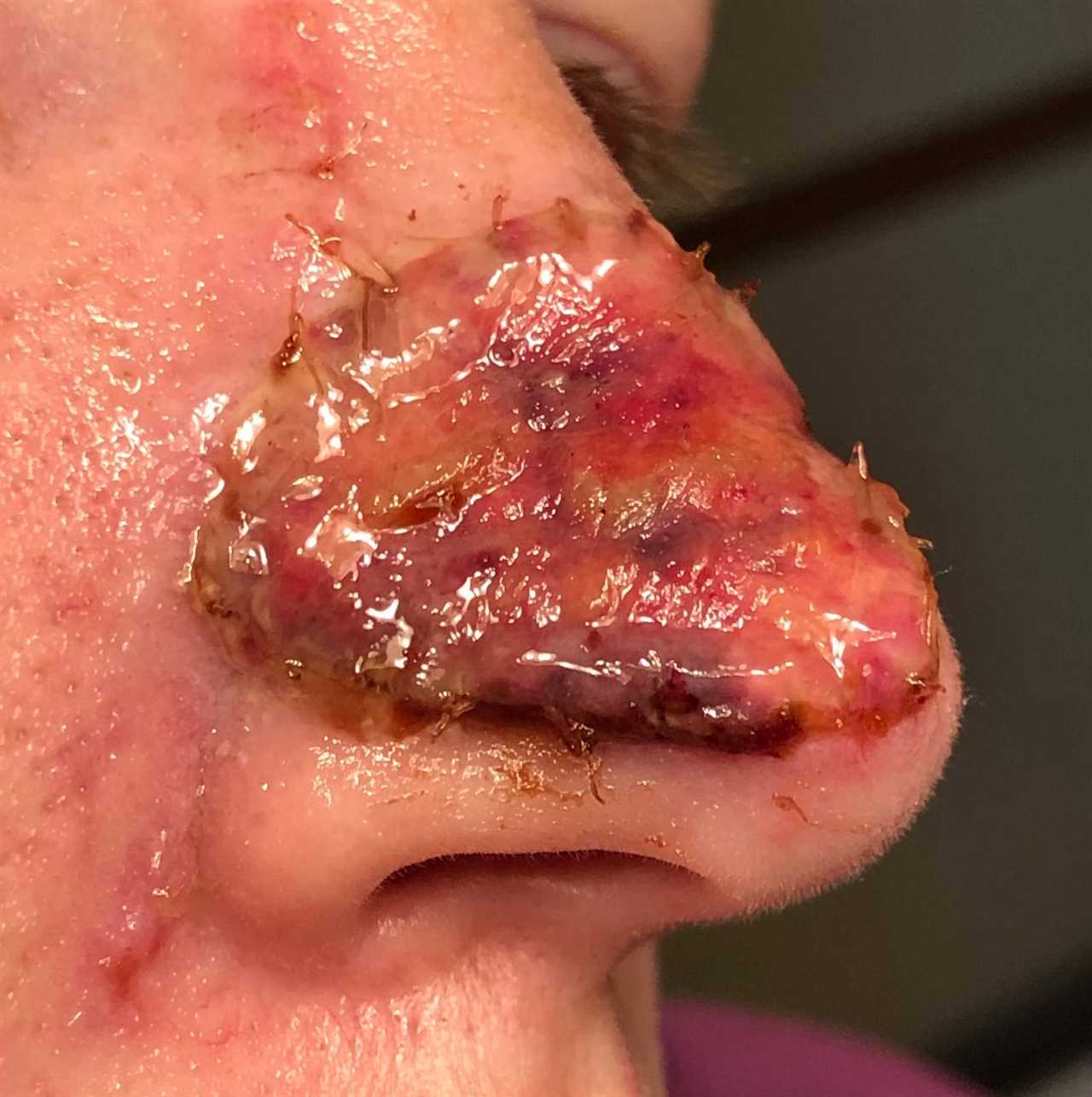 I couldn’t look at myself after acne scar turned cancerous and left gaping hole in my nose