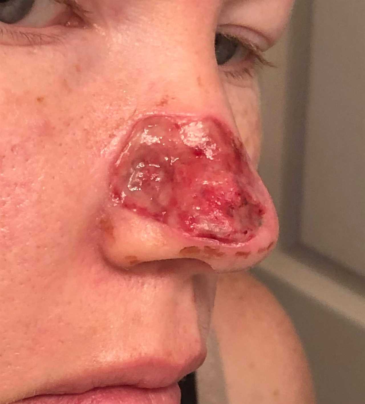 I couldn’t look at myself after acne scar turned cancerous and left gaping hole in my nose