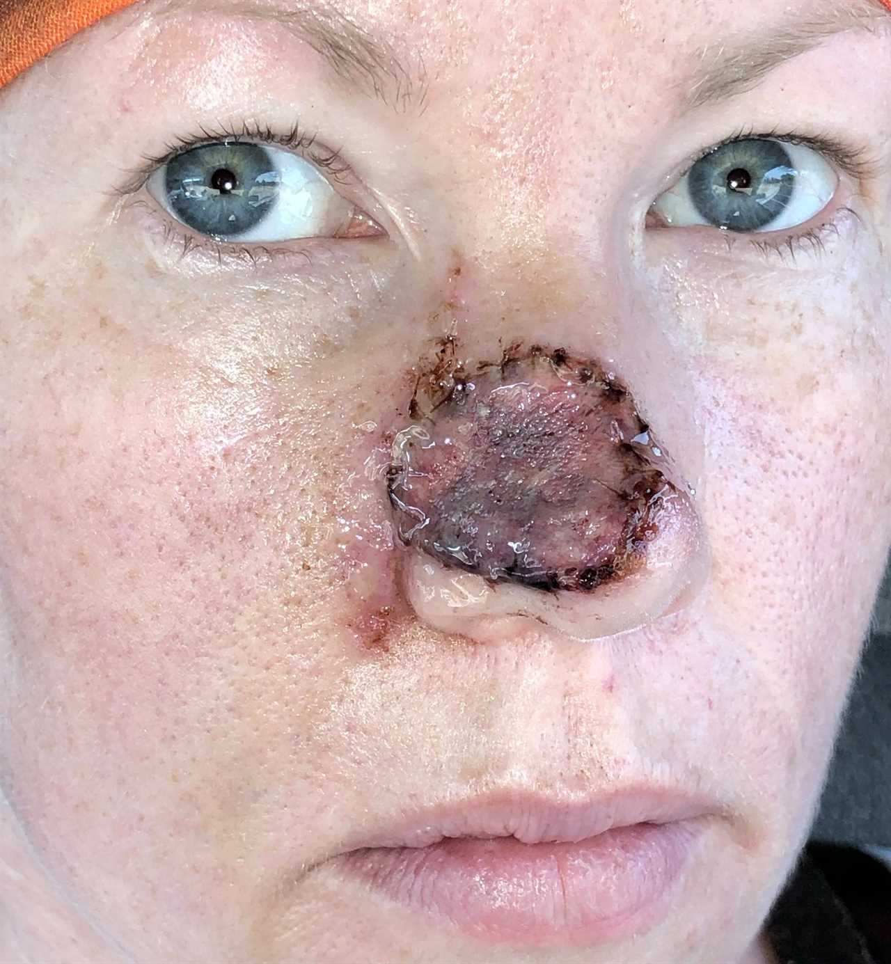 I couldn’t look at myself after acne scar turned cancerous and left gaping hole in my nose
