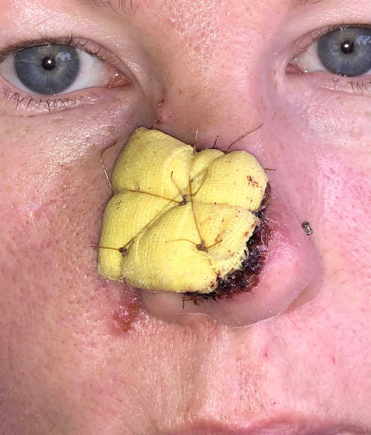 I couldn’t look at myself after acne scar turned cancerous and left gaping hole in my nose