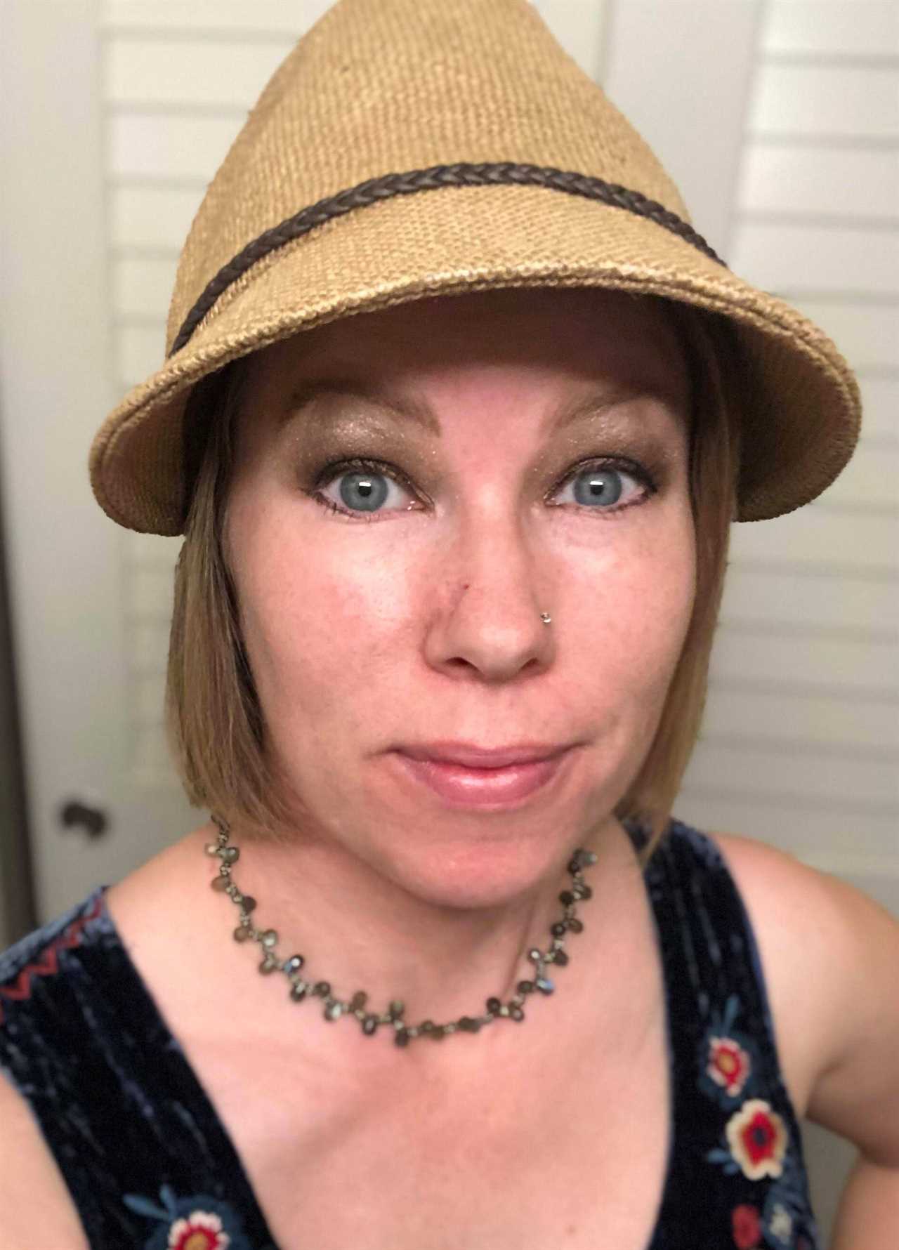 I couldn’t look at myself after acne scar turned cancerous and left gaping hole in my nose
