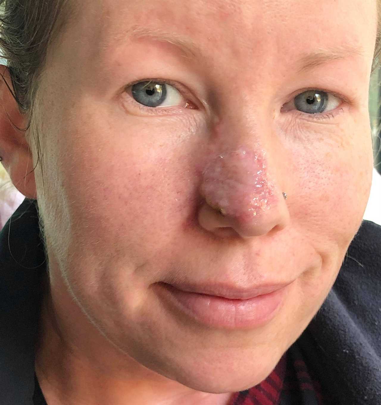 I couldn’t look at myself after acne scar turned cancerous and left gaping hole in my nose