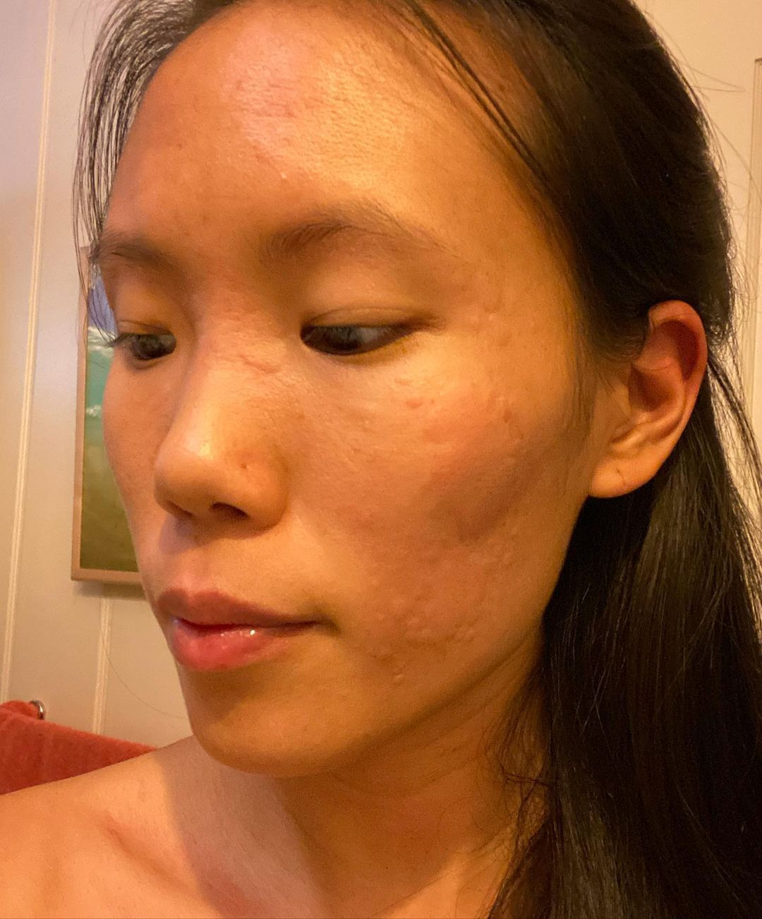 Pics reveal how woman broke out in ‘super itchy’ hives over her face and body after being struck down with Covid