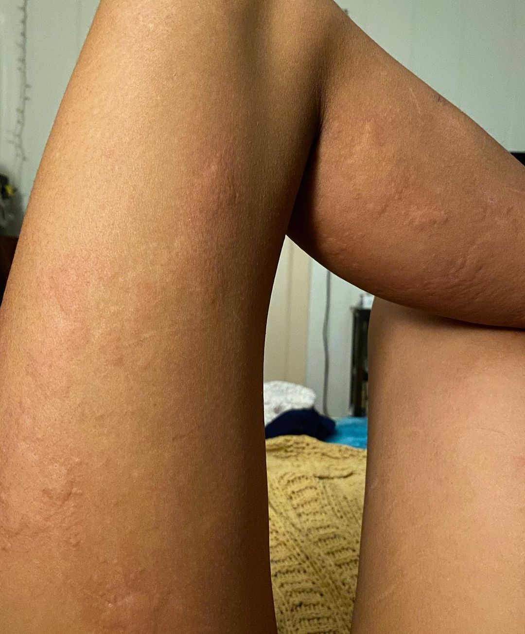 Pics reveal how woman broke out in ‘super itchy’ hives over her face and body after being struck down with Covid