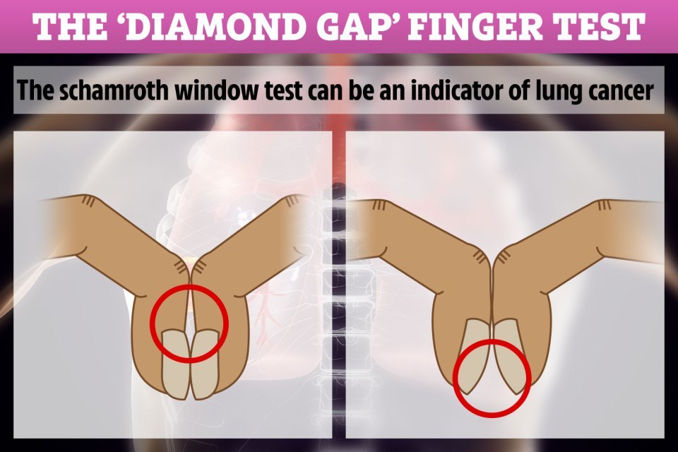 How the ‘diamond gap’ finger test can tell you if you’re at risk of lung cancer