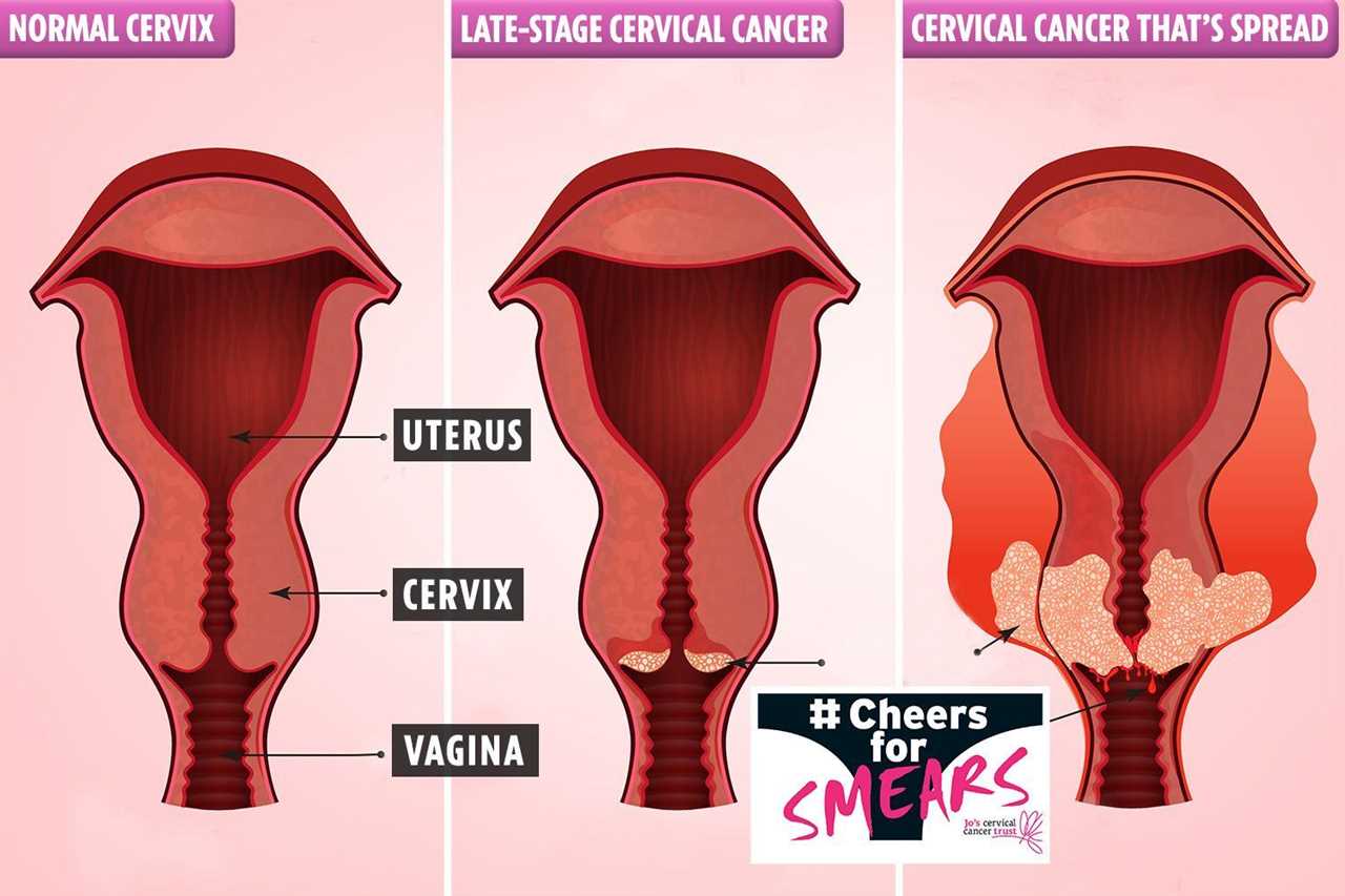 Cervical cancer is almost always treatable if it's caught early on