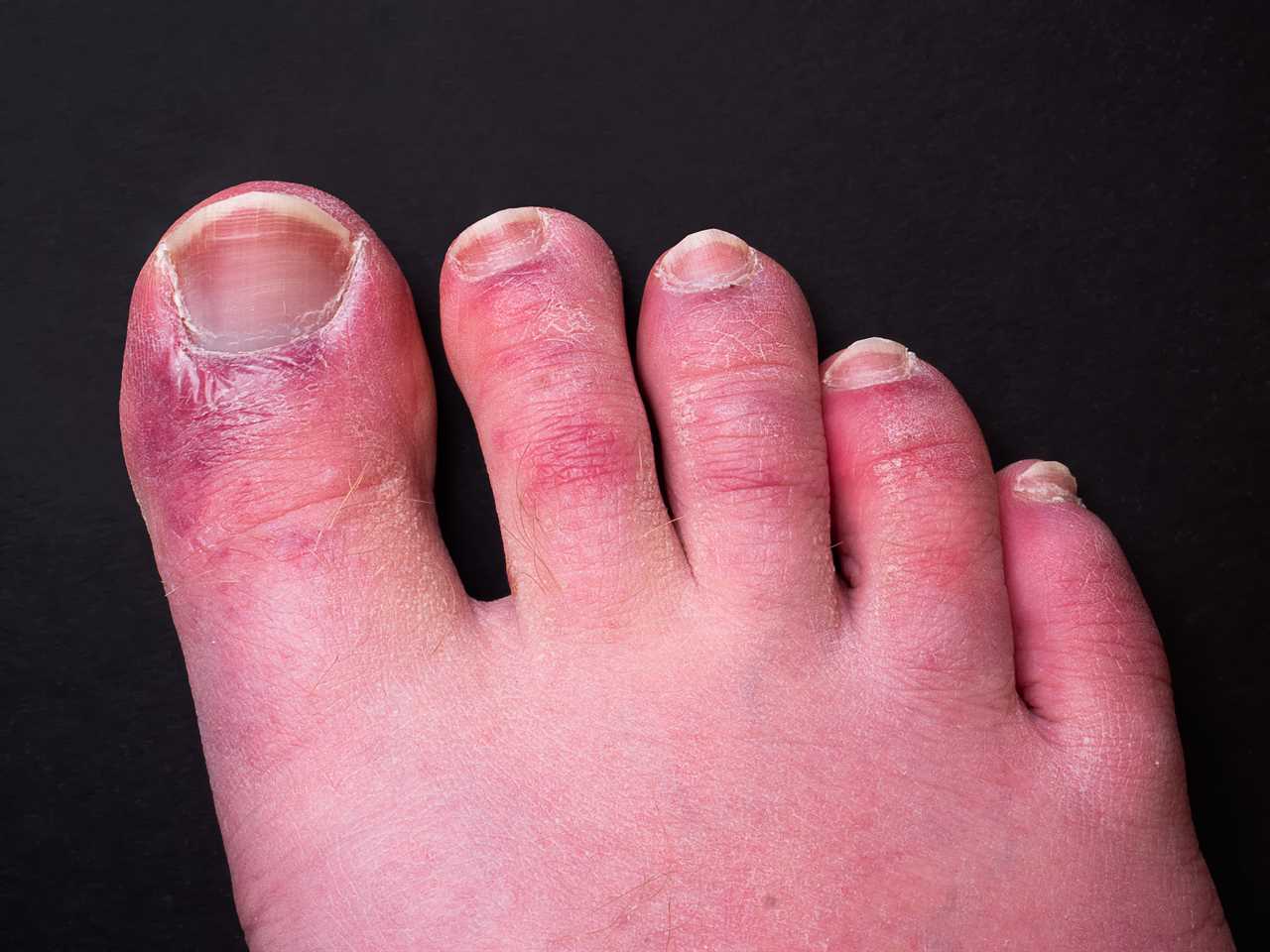 What is Covid toes? What are the symptoms?