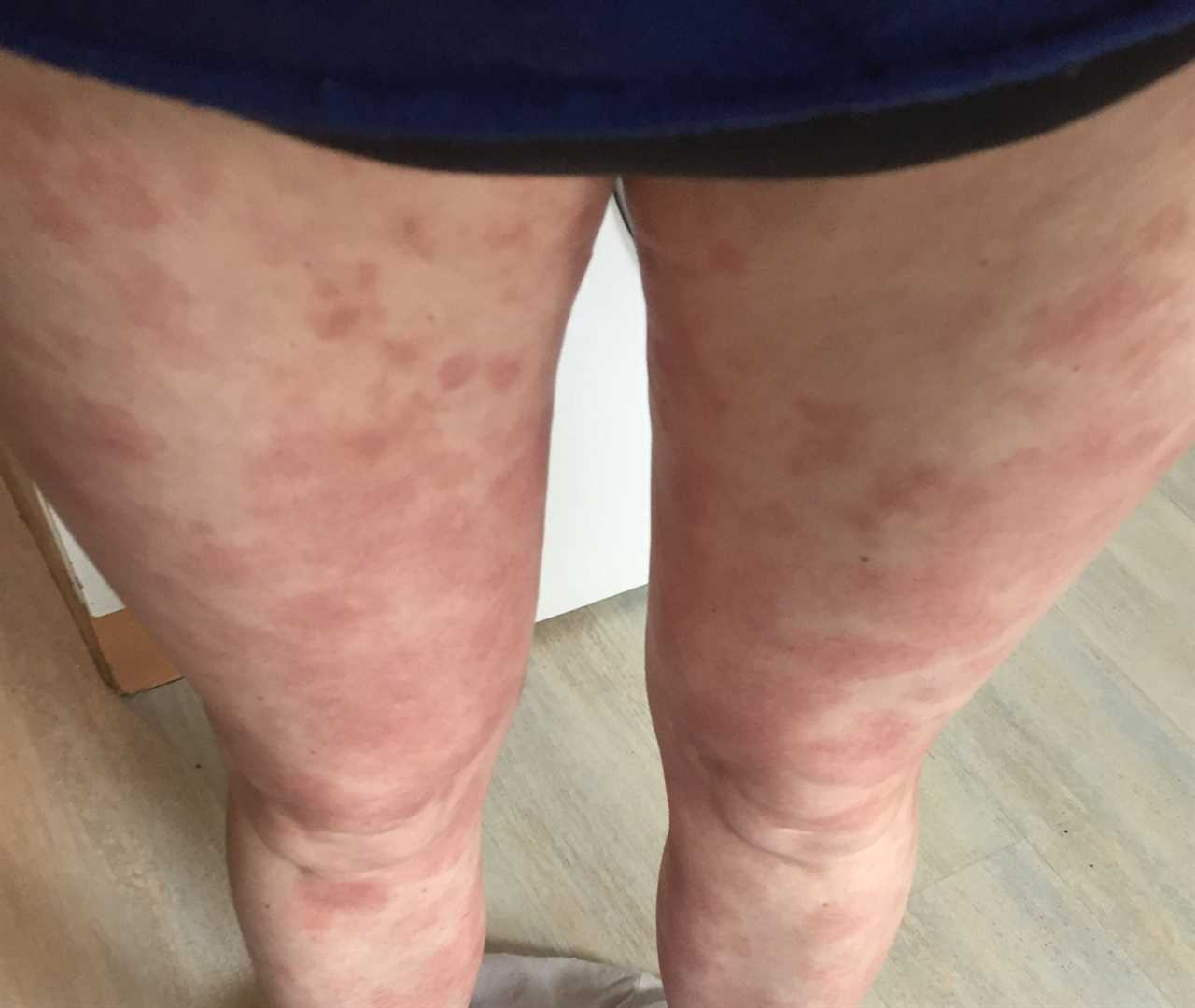 I was in complete shock when doctors told me my ‘eczema’ rash was actually cancer