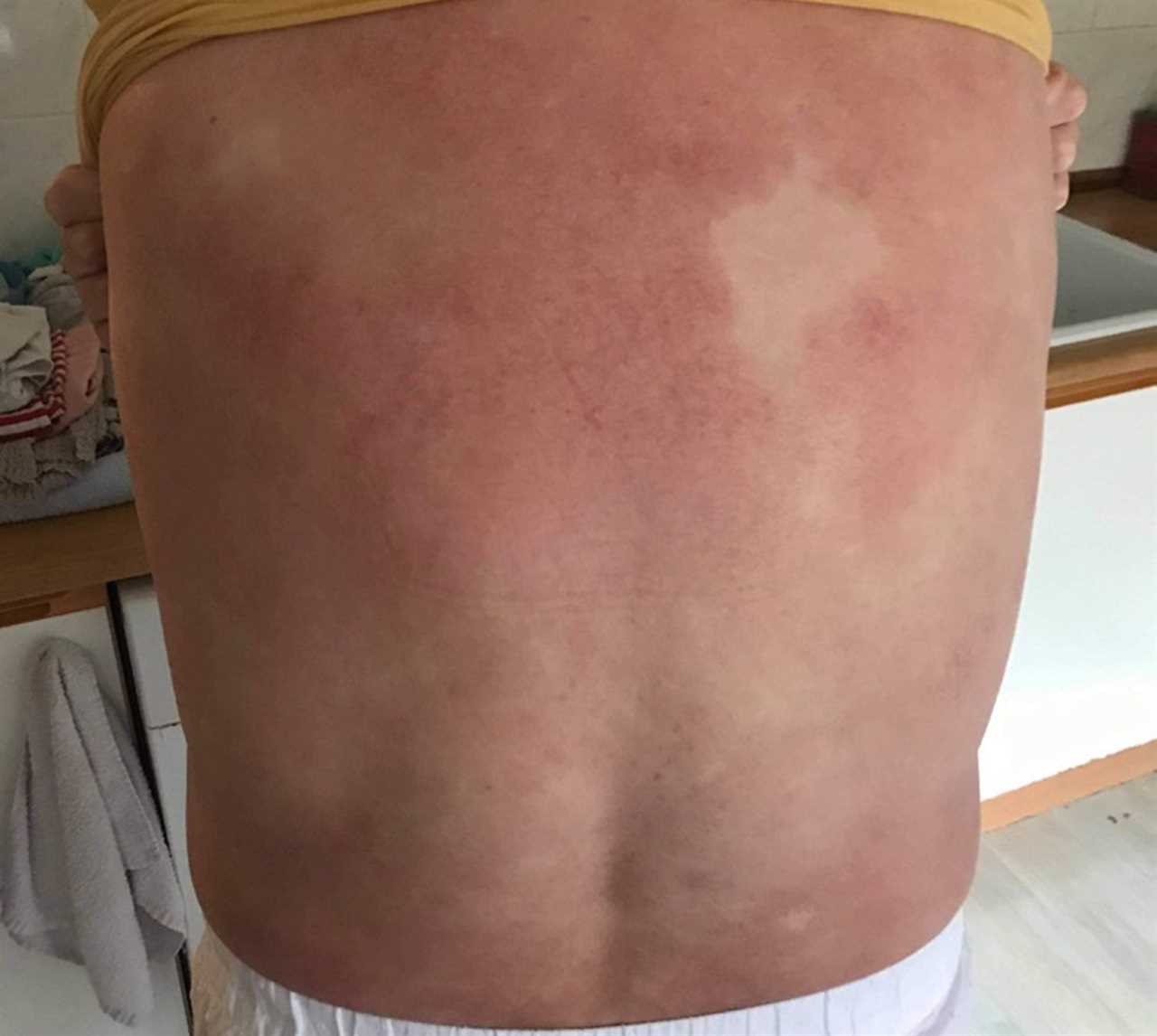 I was in complete shock when doctors told me my ‘eczema’ rash was actually cancer