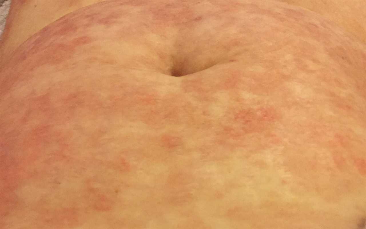 I was in complete shock when doctors told me my ‘eczema’ rash was actually cancer