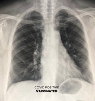 Shocking X-rays reveal the huge difference Covid vaccines really make