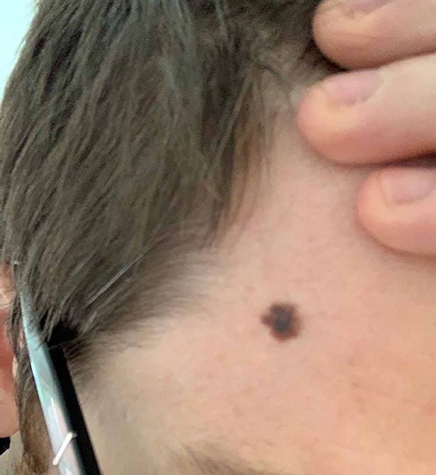 My mum noticed a mole on my head on a family Zoom quiz in lockdown – a few weeks later I was diagnosed with skin cancer