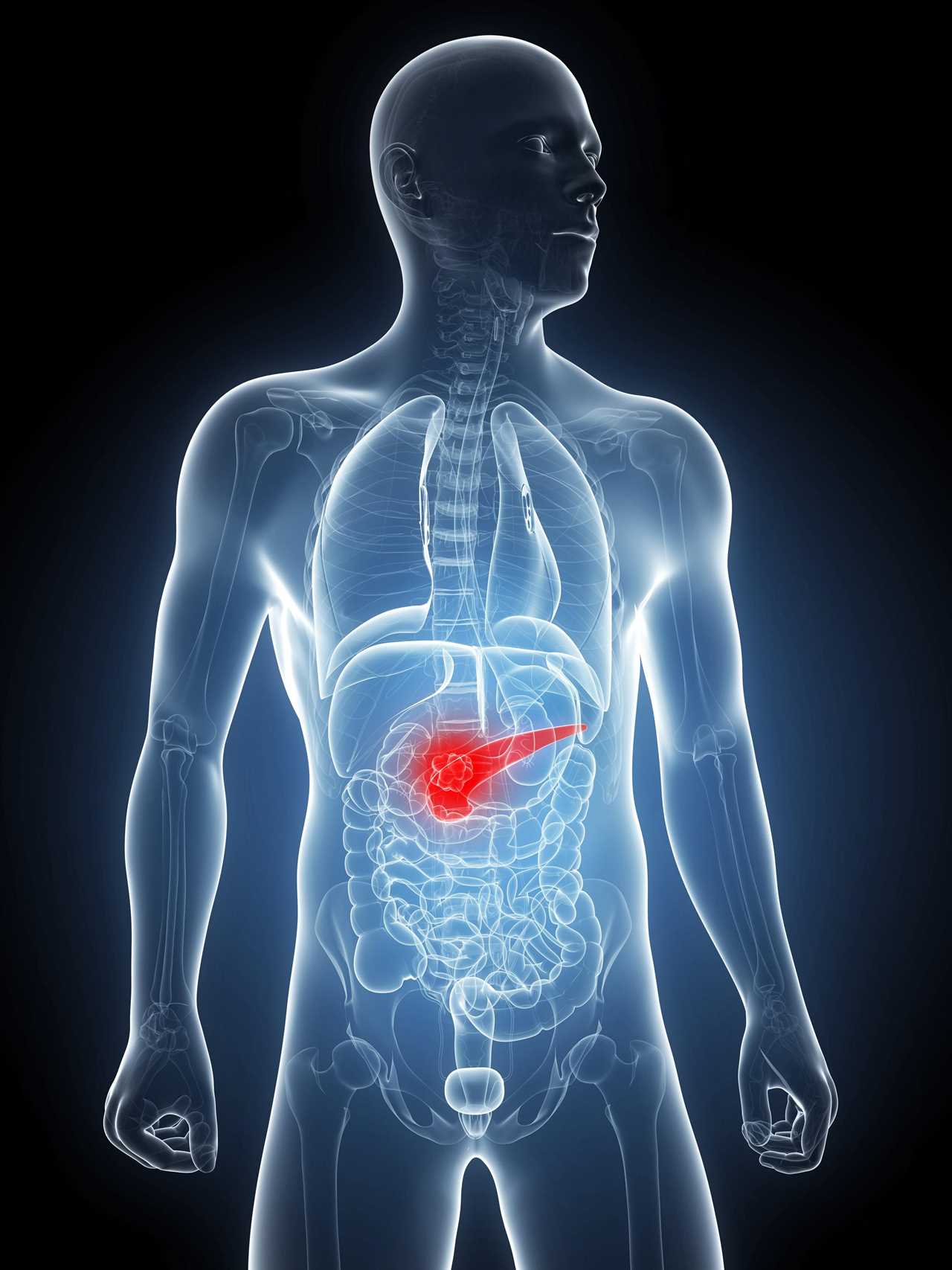 Pancreatic cancer is the deadliest form of the disease because it's so often diagnosed late