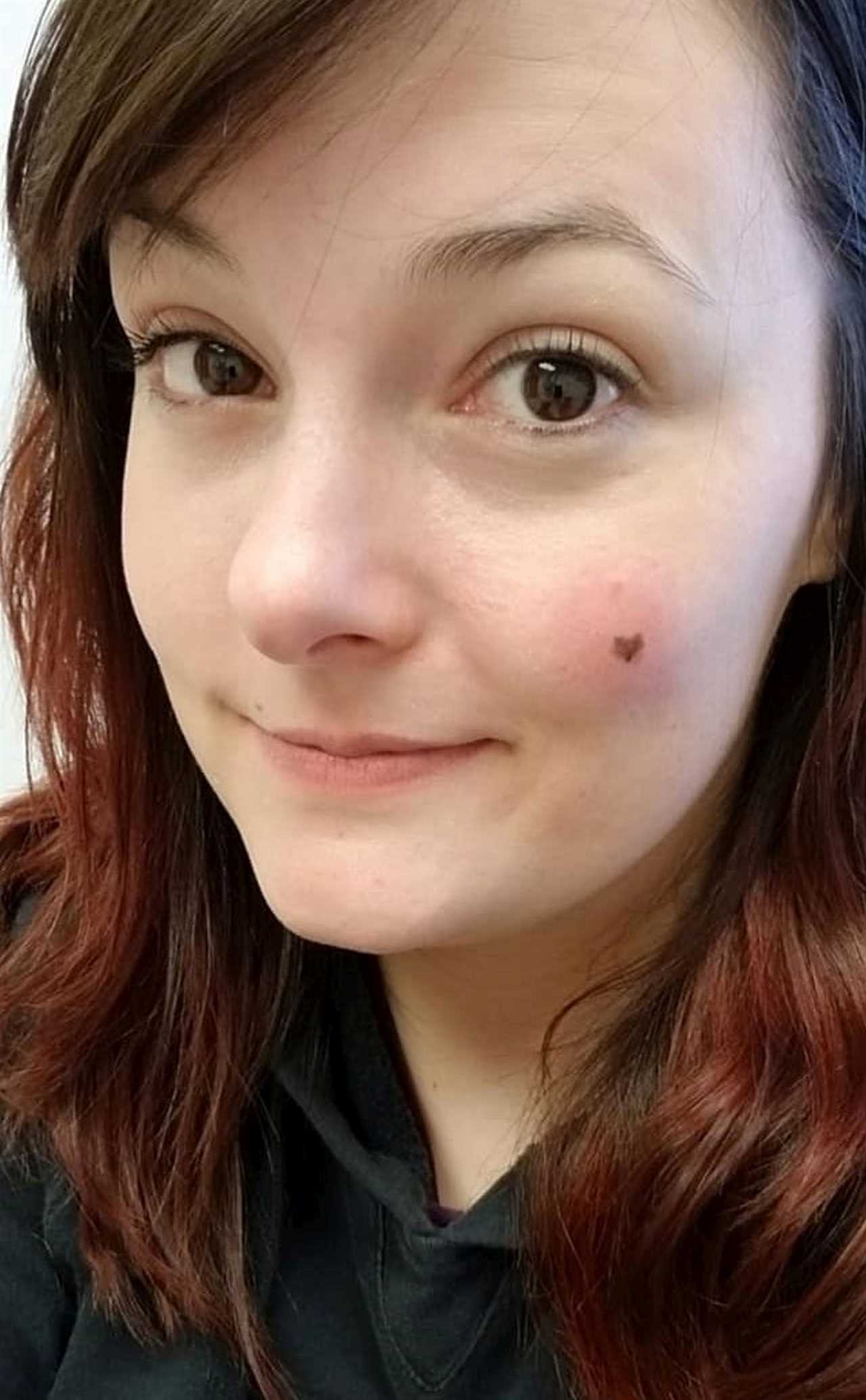 I loved the heart-shaped freckle on my face – until doctors told me it could kill me