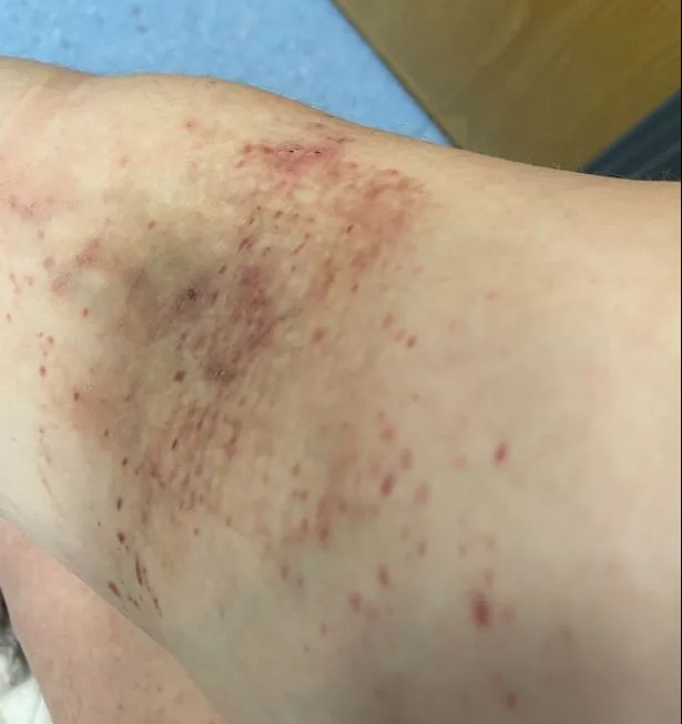 I had no idea my mysterious bruises and ‘low iron’ was actually rare cancer