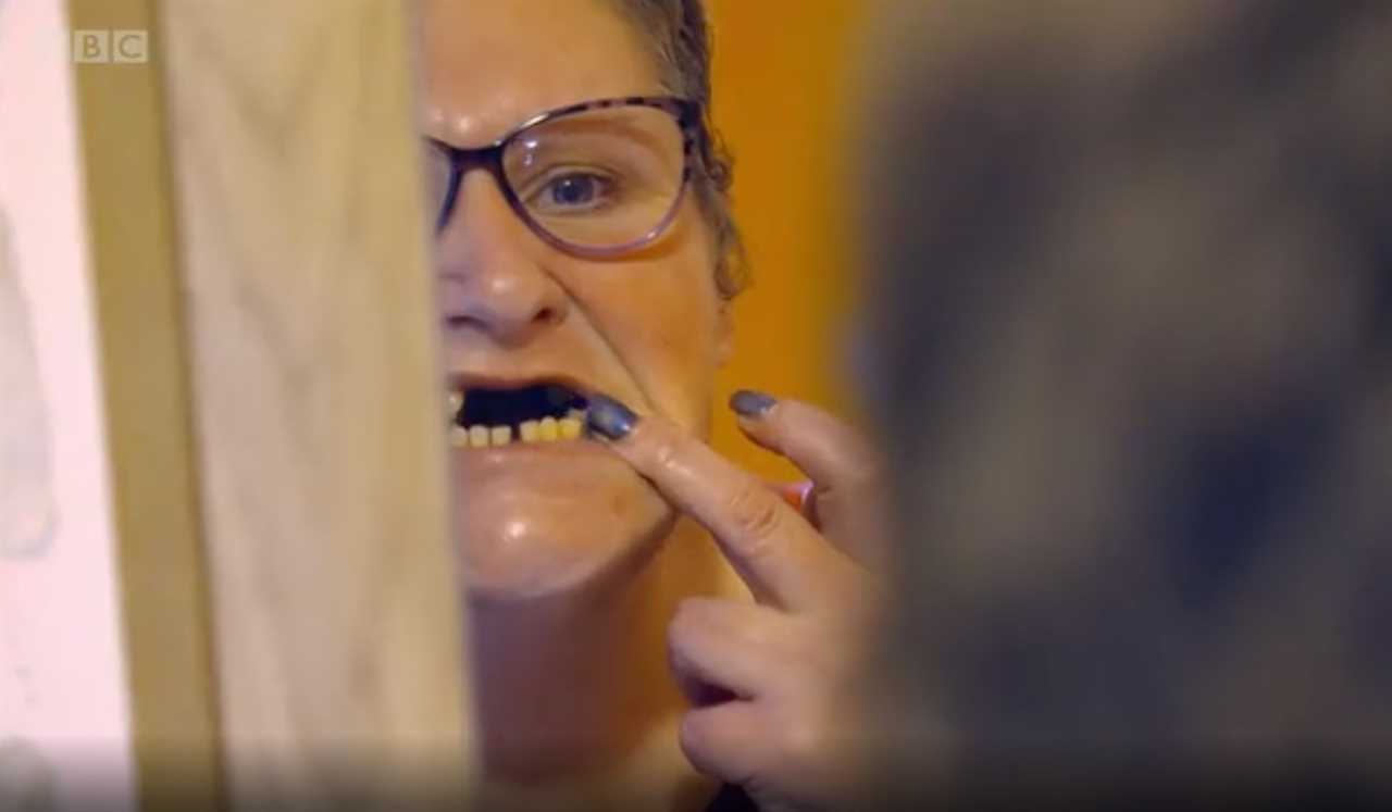 I was so sick of waiting for a dentist I ripped 12 of my teeth out at home – but now I regret it