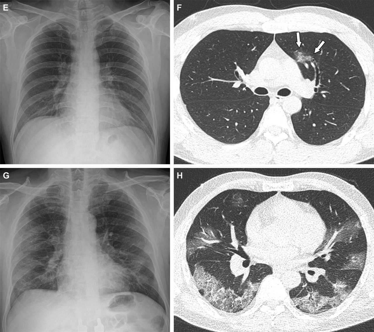 Shocking scans reveal just how important it is to get your Covid vaccines