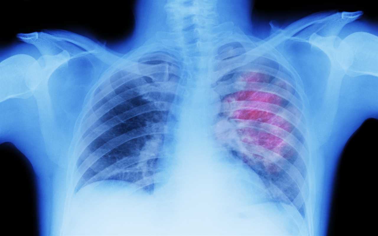 I’m a doctor and these 5 changes could be a sign of deadly lung cancer