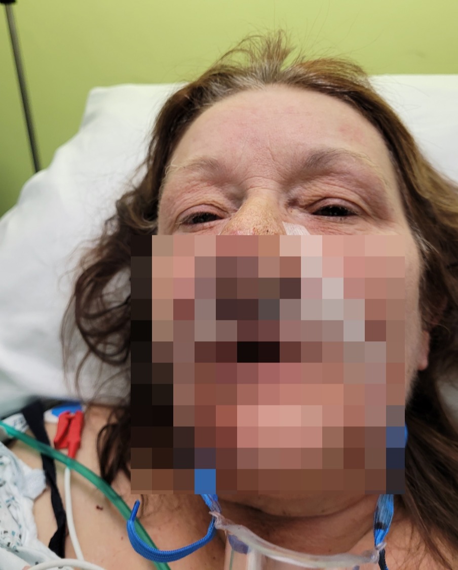 My grandson can’t look at me after ‘wart’ engulfed my nose – and now I need half my face removed