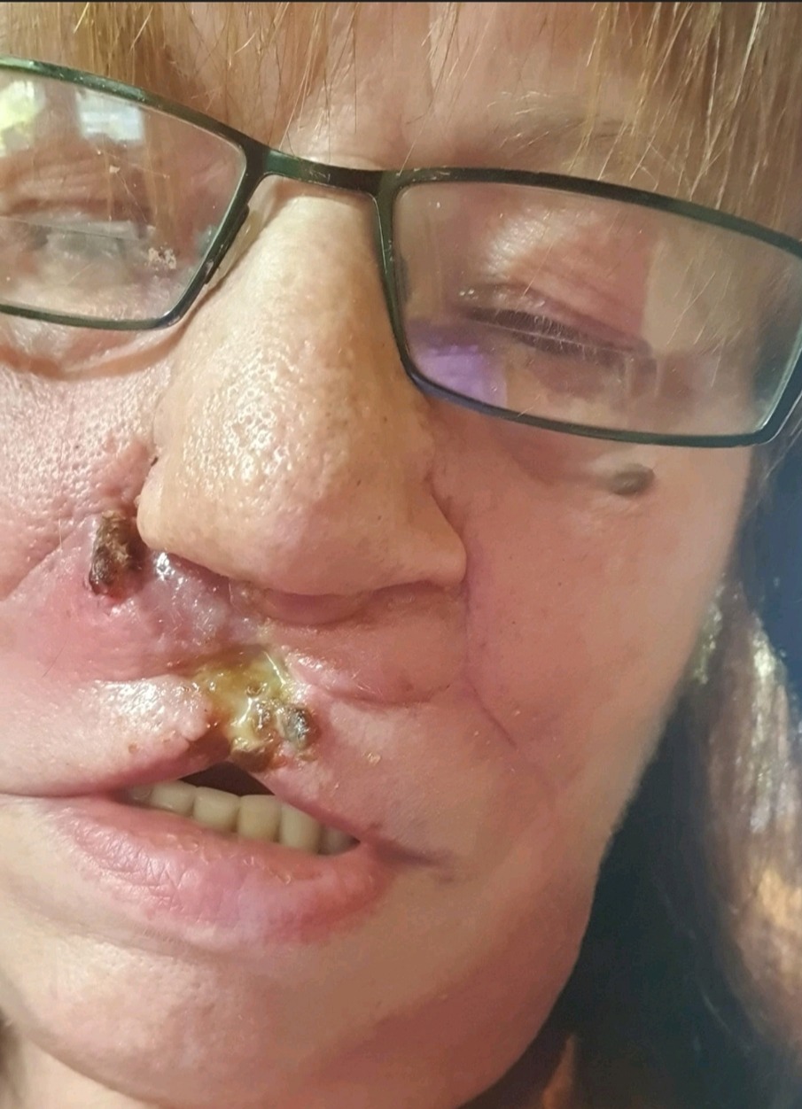 My grandson can’t look at me after ‘wart’ engulfed my nose – and now I need half my face removed