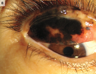 Shocking images show skin cancer in your EYE – the 7 signs to watch out for