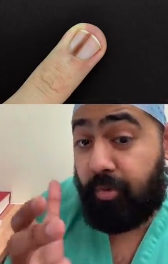 I’m a doctor and here’s the deadly signs on your fingernails you must NEVER ignore