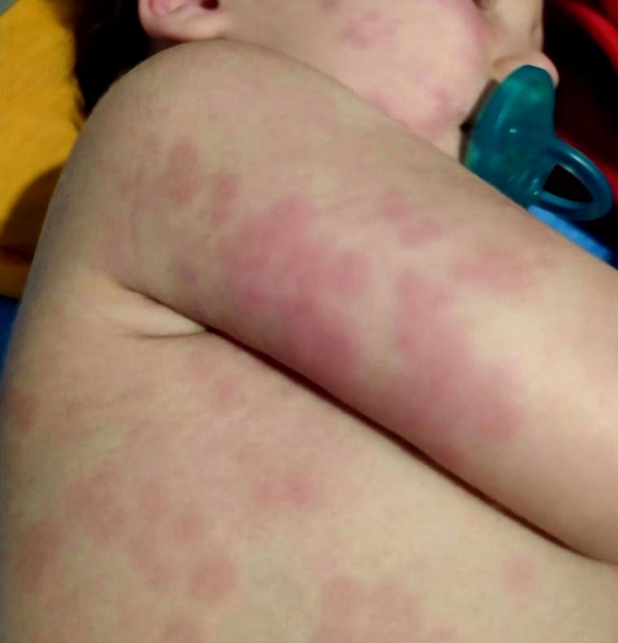 Parents warned to watch out for nasty rash that can strike toddlers with Covid