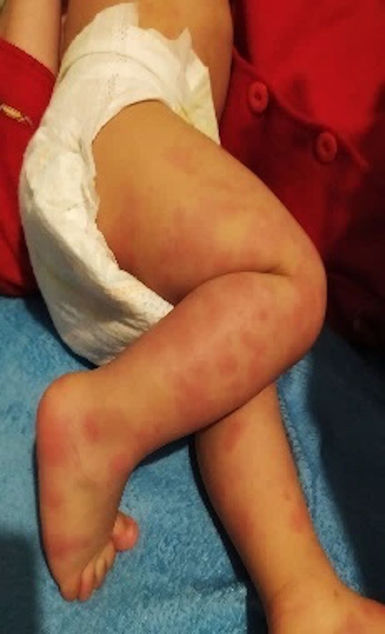 Parents warned to watch out for nasty rash that can strike toddlers with Covid