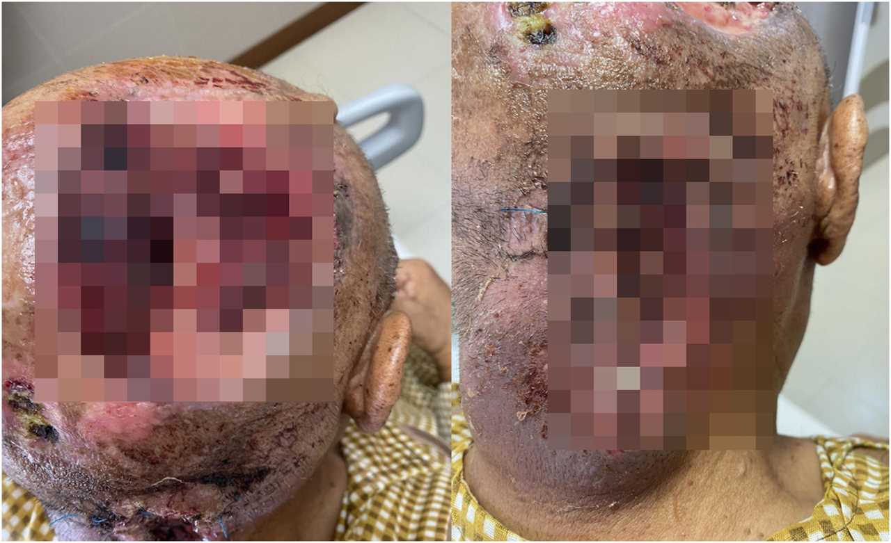 Shocking pictures show man’s scalp ravaged by cancer sparked by common virus