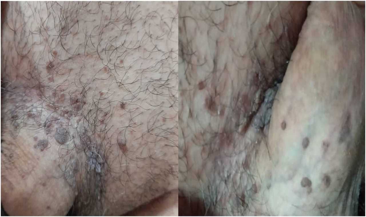 Shocking pictures show man’s scalp ravaged by cancer sparked by common virus