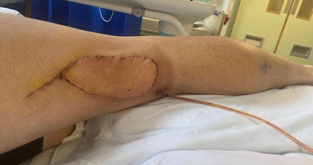 I thought I’d pulled hamstring at football before having lifesaving surgery – it turned out to be something far worse