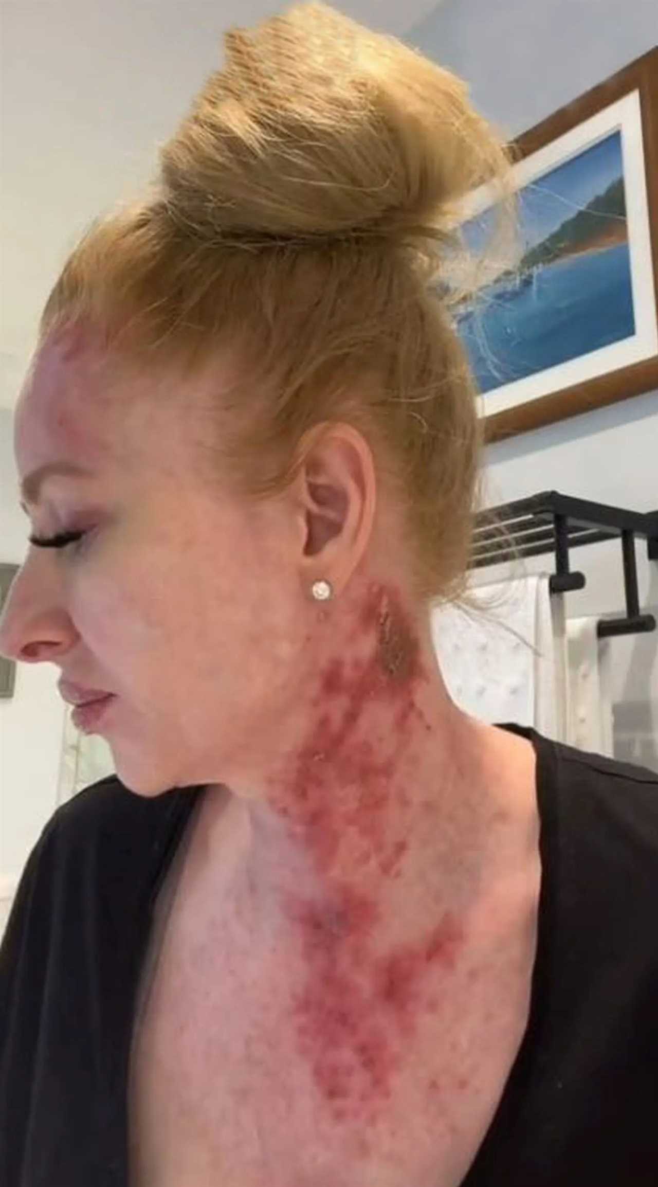 I thought I had eczema on my face but the truth was much worse – I look like an acid attack victim