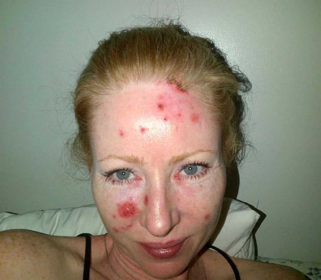 I thought I had eczema on my face but the truth was much worse – I look like an acid attack victim