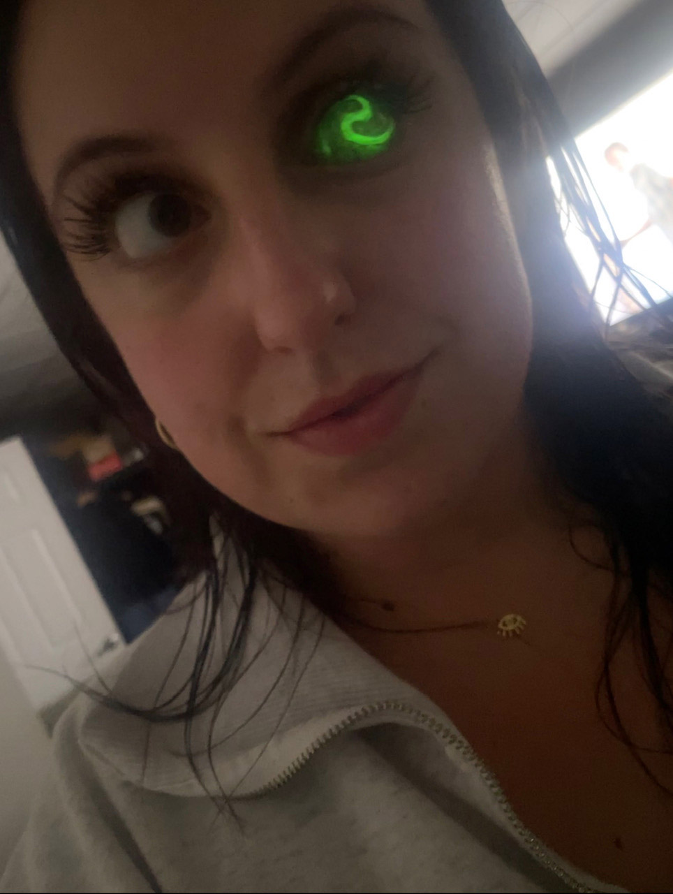 I lost my eye to cancer as a baby – now I have a glow in the dark eyeball