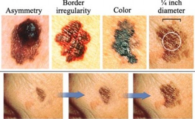 Skin cancer: What are the signs and symptoms – and what does it look like?